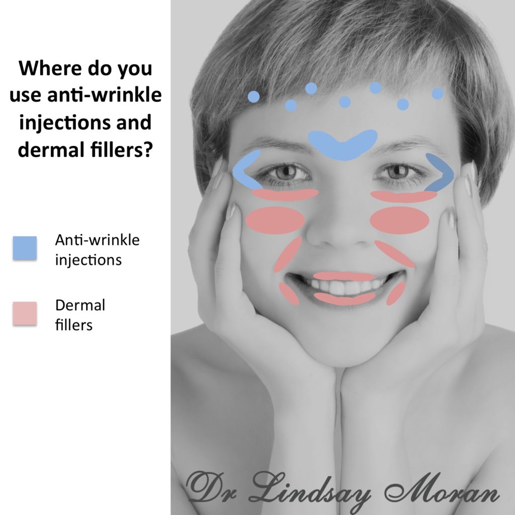 Anti-wrinkle injections vs dermal fillers botox dysport restylane juvederm