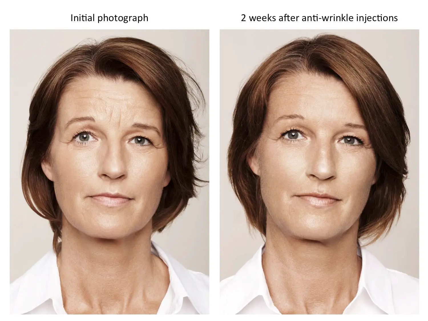 Anti-Wrinkle Injections